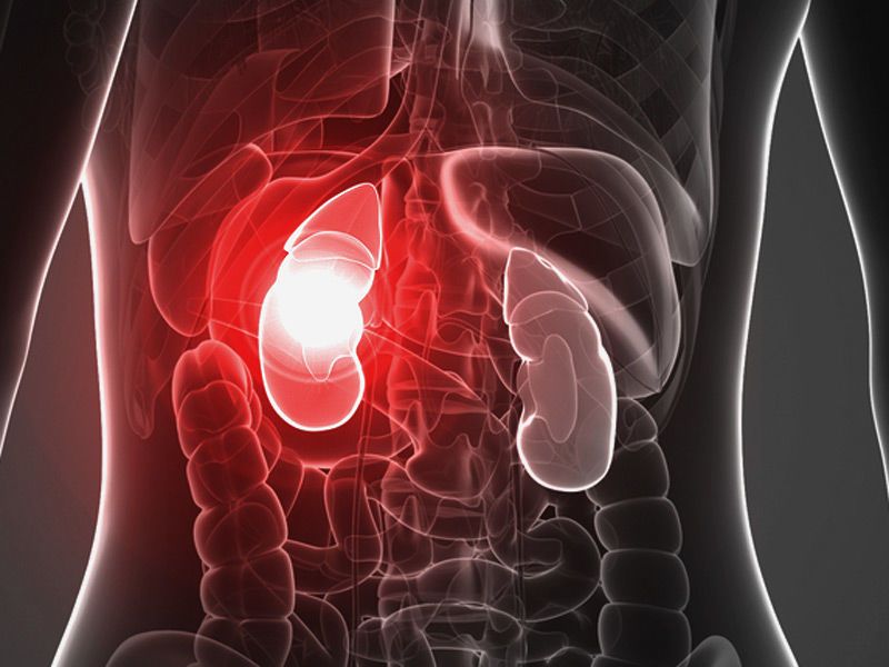 القصور الكلوي الحاد Acute Kidney Injury