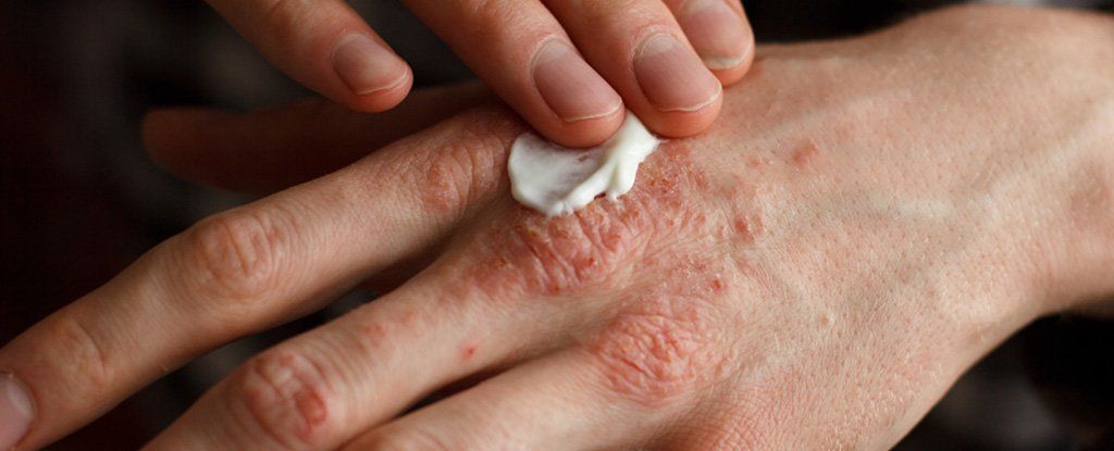 ماذا يحدث في الجلد عند إصابتك بالأكزيما؟ العلماء وجدوا الحلّ أخيرًا