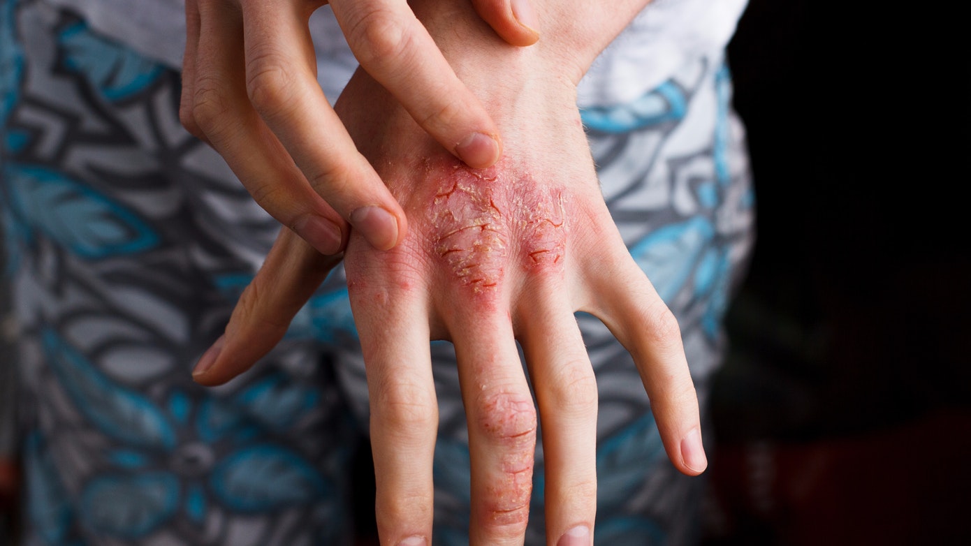 الإكزيما: التهاب الجلد التأتبي