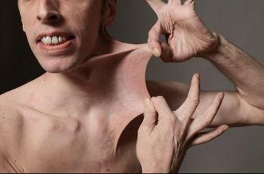 متلازمة إيلر دانلوس أو إهلرز دانلوس Ehlers-Danlos syndrome واختصارًا EDS الأسباب والأعراض والتشخيص وطرق العلاج المفاصل أعضاء الجسم شكل الجسم الأنسجة الضامة الأربطة الأوتار الأوعية الدموية