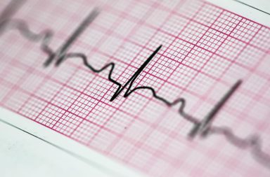 مشكلة في انتظام ضربات القلب - اضطراب النظم الجيبي التنفسي: الأسباب والأعراض والتشخيص والعلاج - بعض أنواع اضطراب النظم الجيبي