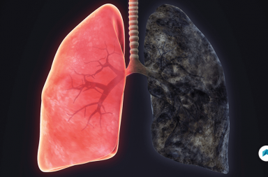 انتفاخ الرئة: الأسباب والأعراض والتشخيص والعلاج - مرض يصيب الرئتين - التهاب القصبات المزمن chronic bronchitis - الحويصلات الرئوية