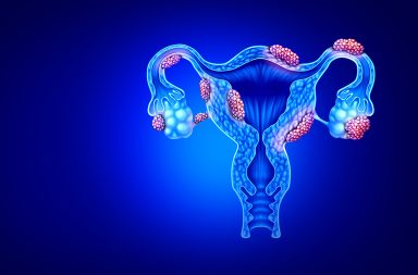 ما الأعضاء التي يمكن أن يصيبها الانتباذ البطاني الرحمي لدى المرأة؟ ما الخيارات العلاجية أمام حالة الانتباذ البطاني الرحمي؟