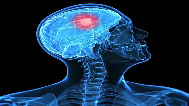 دراسة صادمة تكشف وجود ارتباط بين الدراسات العليا وازدياد احتمال الإصابة بأورام الدماغ