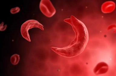 فقر الدم المنجلي: الأسباب والأعراض والتشخيص والعلاج sickle cell anemia أو داء الخلايا المنجلية SCD كريات الدم الحمراء RBCs