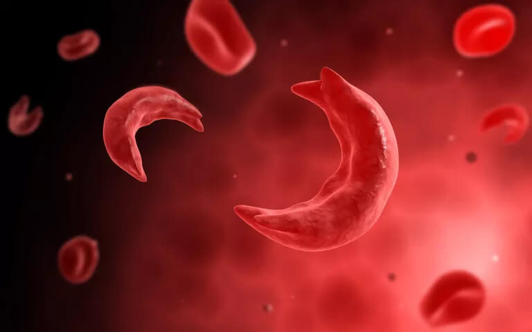فقر الدم المنجلي: الأسباب والأعراض والتشخيص والعلاج
