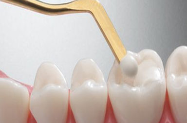 ما يجب أن تعرفه عن الحشوات المركبة «حشوات الكومبوزيت» - ماهية الحشوات المركبة، ومدة استمرارها، وأمانها - لماذا قد ينصحك طبيب بحشو أسنانك؟