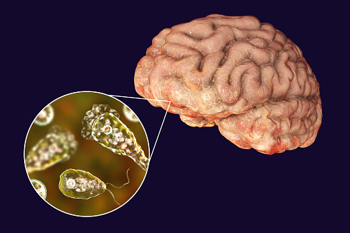 عدوى النيغلرية (الأميبا الآكلة للدماغ): الأسباب والأعراض والتشخيص والعلاج