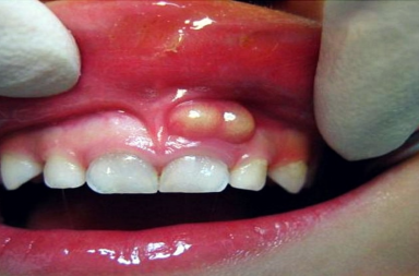 علاج خراج الأسنان وأسبابه