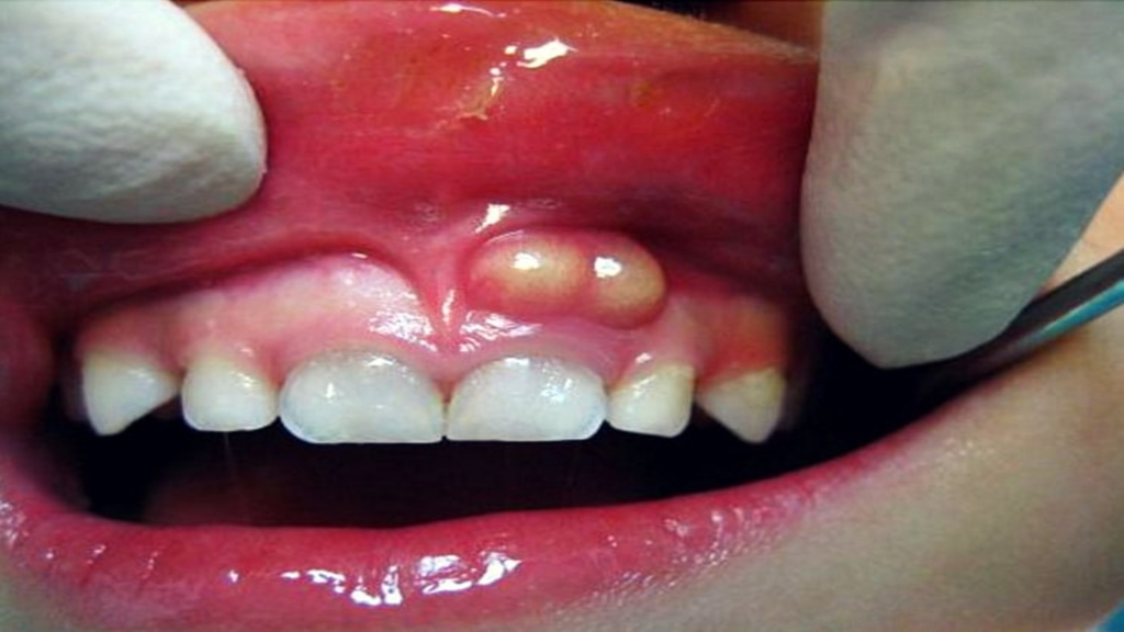 الخراج بين اللثة والأسنان: ما أسباب وعلاج خراج اللثة والأسنان
