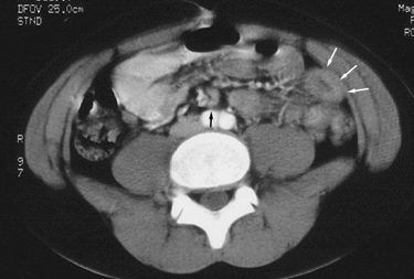 التهاب العقد المساريقية Mesenteric Adenitis الأسباب والأعراض والتشخيص والعلاج الغدد اللمفاوية في النسيج المسمى المساريقي Mesentery