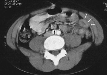 التهاب العقد المساريقية Mesenteric Adenitis