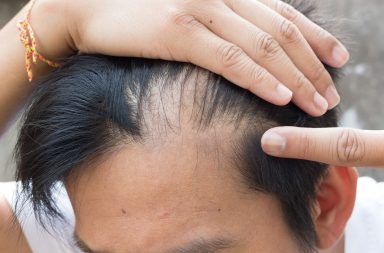 أسباب الثعلبة أعراض الثعلبة أسباب فقدان الشعر الموضعي علاج فقدان الشعر الموضعي التشخيص أسباب وراثية التعرض للشمس بصيلات الشعر