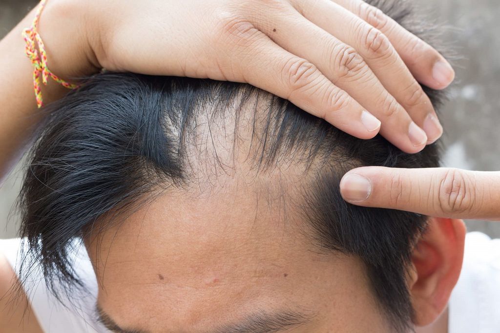 الثعلبة أو فقدان الشعر الموضعي: الأسباب والأعراض والتشخيص والعلاج