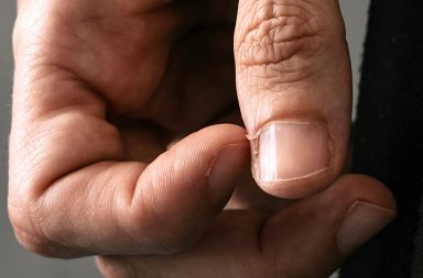 الظفر المعلق (السأف): الأسباب والعلاج - القطع الخشنة المزعجة من الجلد، التي تبرز من جانب الأظفار ونادرًا ما تظهر في أصابع القدم
