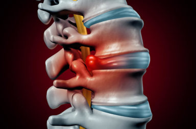 ما هو القرص الفقري الناتئ ؟ وما مدى خطورة الحالة؟ ما هي أسباب وعوامل خطر الإصابة ببروز الأقراص في الظهر؟ الحفاظ على العمود الفقري
