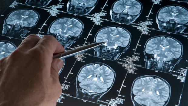 اكتشاف منطقة في الدماغ تستجيب للعلاج الوهمي « تاثير البلاسيبو » !