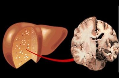 الاعتلال الدماغي الكبدي الأسباب والاعراض والتشخيص والعلاج إزالة السموم من الدم التهاب الكبد الفيروسي تلف في الدماغ ضعف في وظائف الدماغ