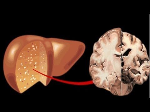 الاعتلال الدماغي الكبدي: الأسباب والاعراض والتشخيص والعلاج
