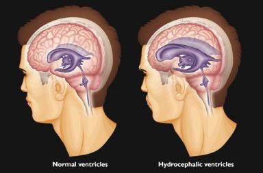 استسقاء الدماغ أو موه الرأس: الأسباب والأعراض والتشخيص والعلاج تراكم السائل الدماغي الشوكي في تجاويف الدماغ ارتفاع الضغط داخل القحف