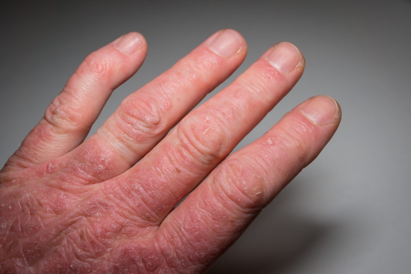 التهاب الأصابع (الأصابع السجقية): الأسباب والأعراض والتشخيص والعلاج