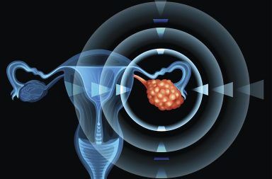 أورام المبيض الحميدة Noncancerous Ovarian Growths الأسباب اولأعراض والتشخيص والعلاج الأكياس الوظيفية الأورام الليفية الأورام الحميدة