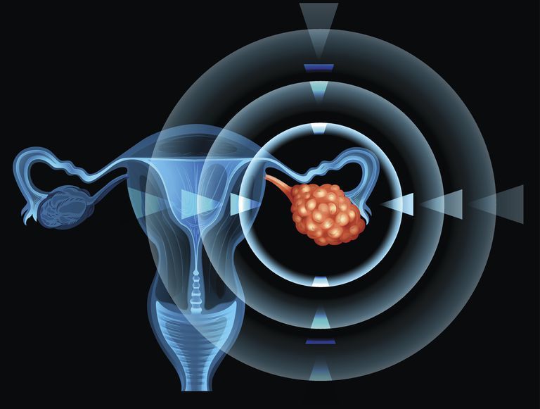 أورام المبيض الحميدة Noncancerous Ovarian Growths