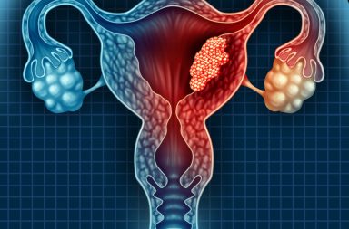 ما الأعراض الرئيسية لسرطان الرحم؟ من هم الأكثر عرضة للإصابة بسرطان الرحم؟ كيفية تقليل مخاطر الإصابة بسرطان الرحم. علاج سرطان الرحم