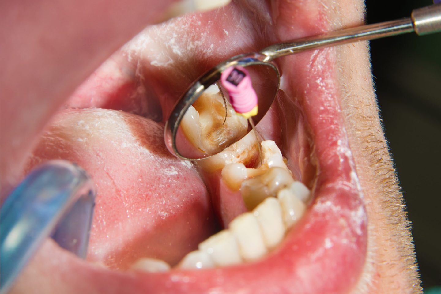 تقنية جديدة قد تنقذك من المعاناة عند طبيب الأسنان