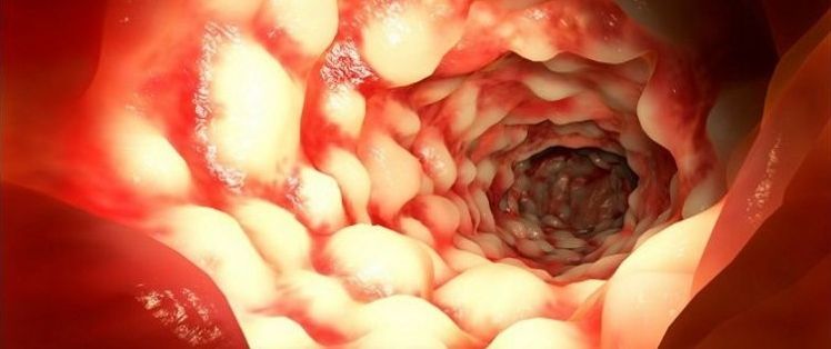 ما هو داء كرون Crohn's Disease؟ الأسباب والأعراض والتشخيص والعلاج