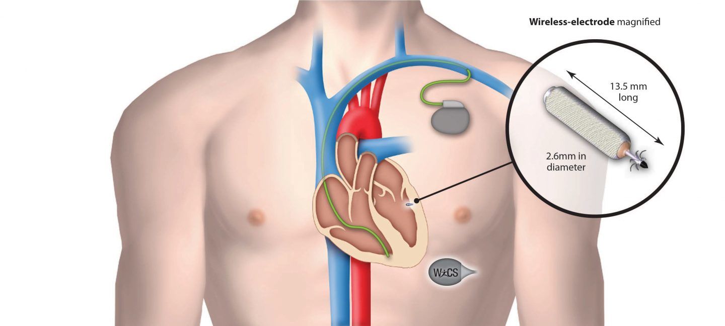 منظم ضربات القلب اللاسلكي الجديد يمنع حدوث المضاعفات الشائعة