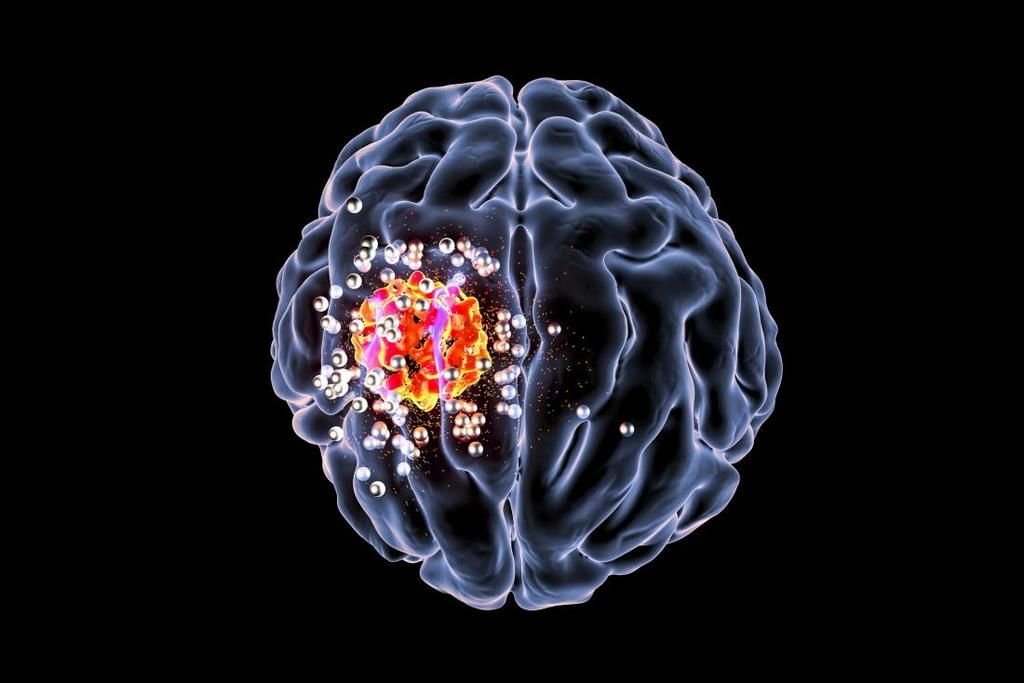 الأورام الدماغية: الأسباب والأعراض والتشخيص والعلاج