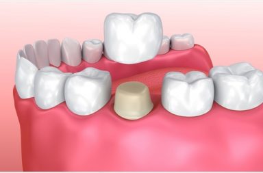 ألم تاج الأسنان: الأسباب والعلاج - تيجان الأسنان تغطي الأسنان المتضررة وتحميها من المؤثرات الخارجية - الحساسية أو الضغط أو الألم المستمر في موضع التاج