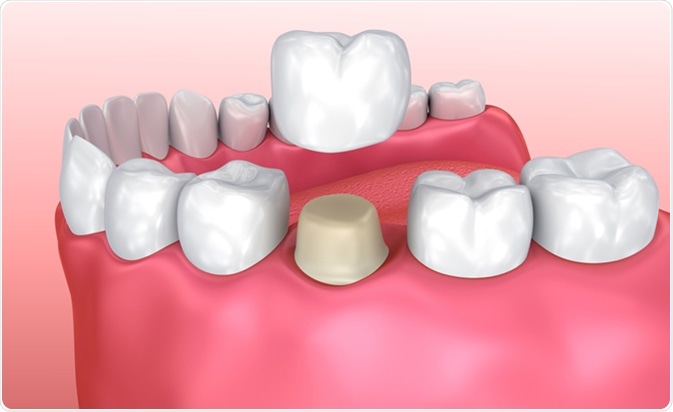 ألم تاج الأسنان: الأسباب والعلاج