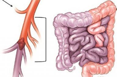 الإقفار المساريقي الحاد أو الجلطة المعوية Acute Mesenteric Ischemia الأسباب والأعراض والتشخيص والعلاج توقف مفاجئ في جريان الدم إلى جزء من الأمعاء