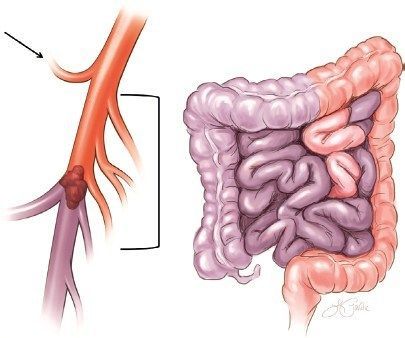 الإقفار المساريقي الحاد أو الجلطة المعوية Acute Mesenteric Ischemia