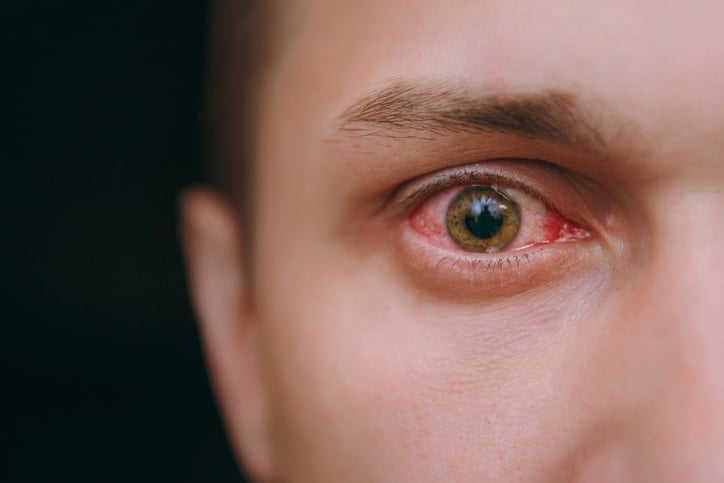 ما أسباب احمرار العين؟ وكيف نميز بين ما هو مرضي وما هو عادي؟