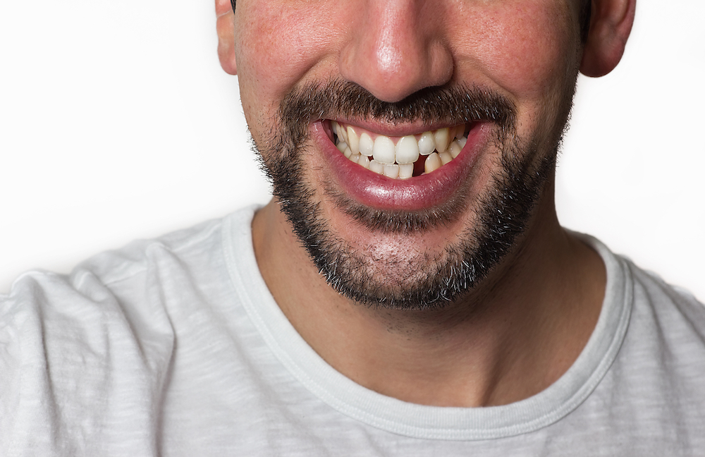ماذا يجب أن تفعل حين يسقط سن من أسنانك؟
