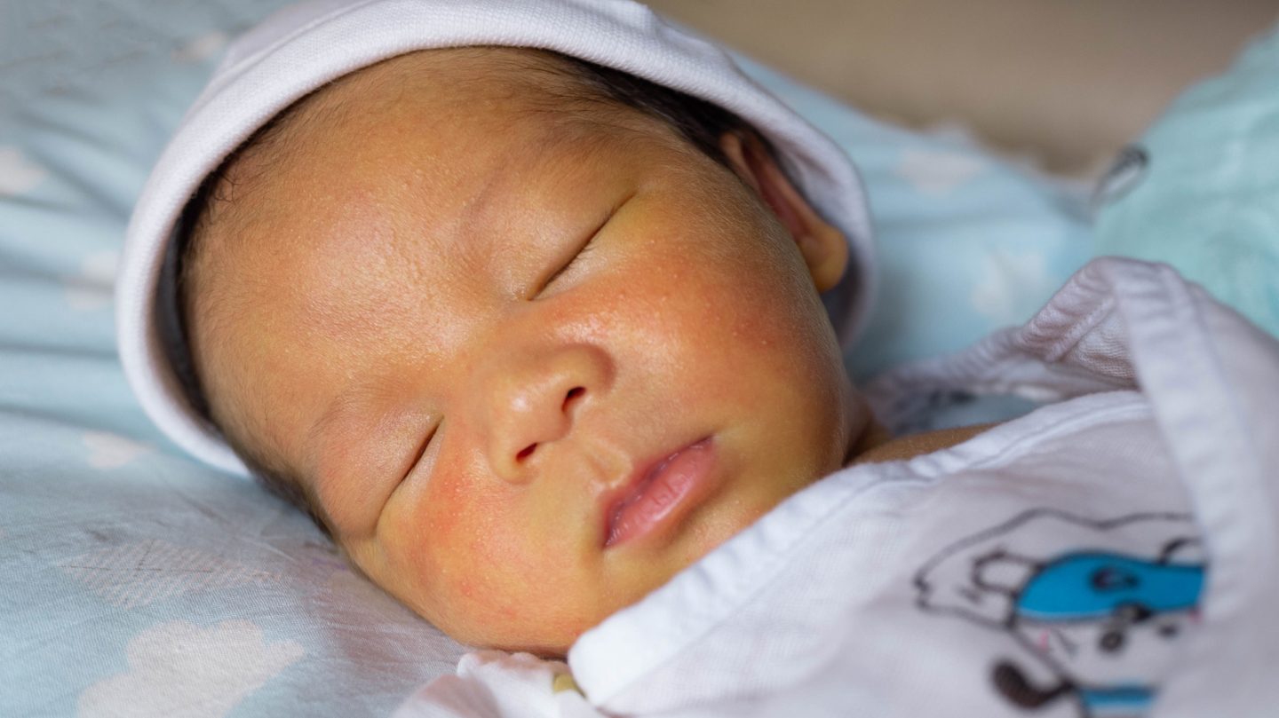 يرقان الرضع حديثي الولادة: الأسباب والأعراض والتشخيص والعلاج