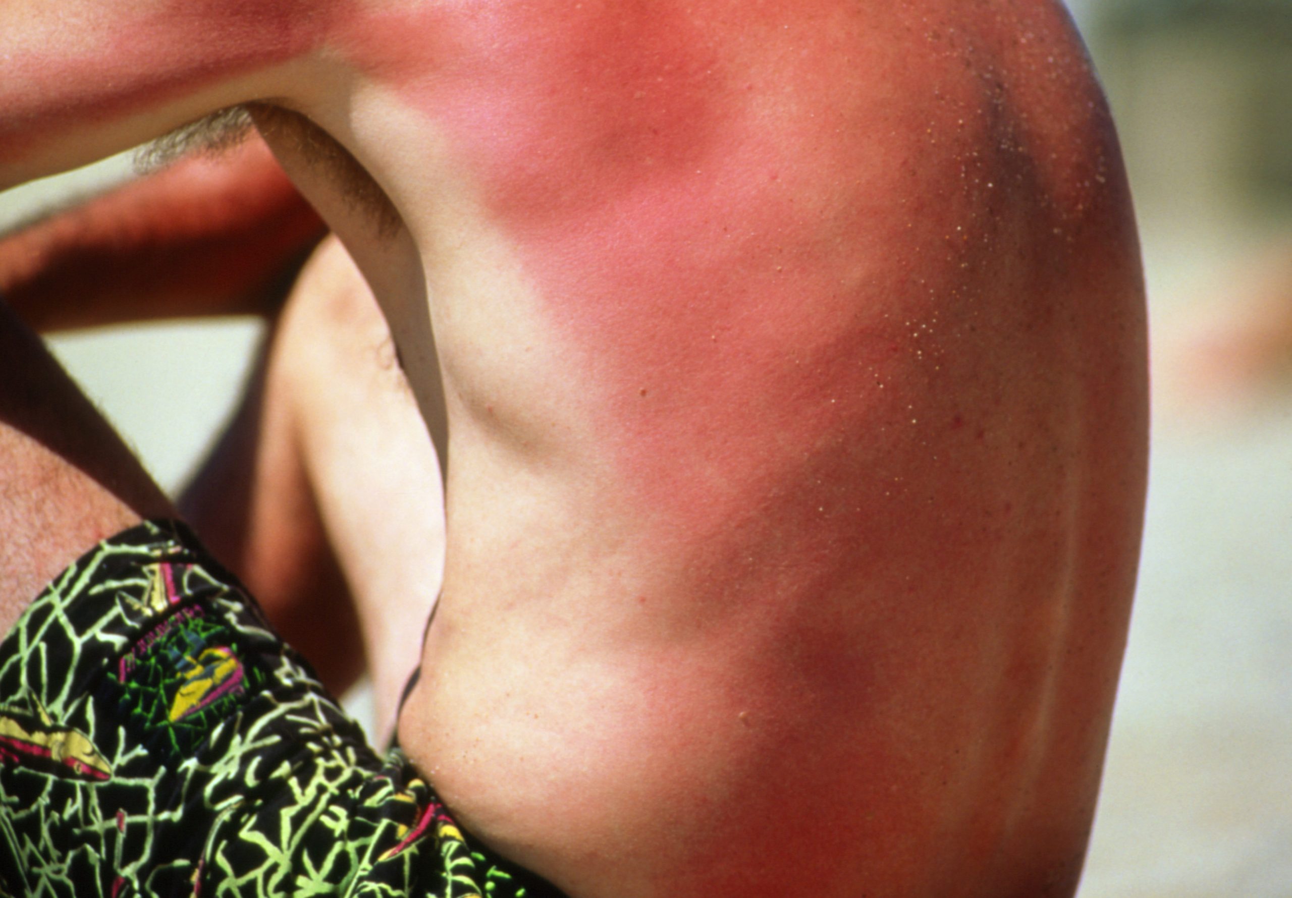 مع اقتراب فصل الصيف، كيف تقي جسمك من حروق الشمس - التعرض المفرط للأشعة فوق البنفسجية الصادرة عن الشمس - الإصابة بسرطان الجلد