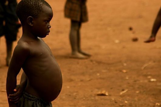 لماذا ينتفخ بطن الأطفال الذين يعانون من سوء التغذية؟