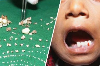 أطباء الأسنان قلعوا أكثر من 500 سن لطفل بعمر السبعة أعوام إجراء عملية لقلع 500 سن لطفل بعمر السابعة قلع الأسنان عند طفل هندي صغير