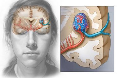 أسباب التشوه الشرياني الوريدي علاج التشوه الشرياني الوريدي الأسباب والأعراض والتشخيص والعلاج الدماغ الأم الجافية مرور الدم الأوردة الشرايين