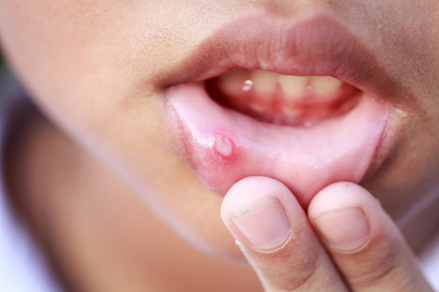قرحة الفم؛ الأسباب والأعراض والتشخيص والعلاج