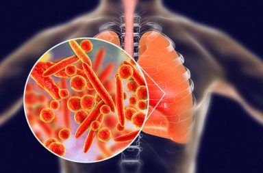 ذات الرئة بالمفطورات Mycoplasma pneumonia : الأسباب والأعراض والتشخيص والعلاج مرض تنفسي معدي ينتقل عن طريق الإفرازات الرئوية