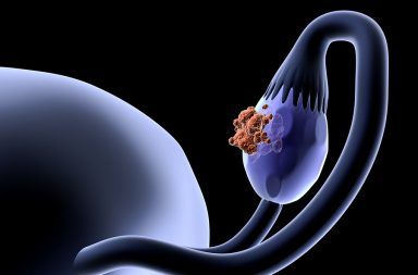 سرطان المبيض: ما هي الأعراض الباكرة وكيف تكتشفينها شذوذ بعض الخلايا في المبيض وانقسامها بشكل غير مضبوط أورام المبيض عند المرأة