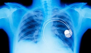 ما هي التقنية التي ستتفوق على منظم ضربات القلب الاصطناعي (pacemaker)؟