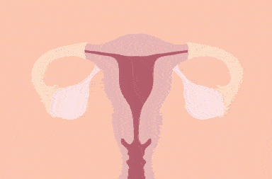 الانتباذ البطاني الرحمي: الأسباب والأعراض والتشخيص والعلاج انغراسات بطانية رحمية منشؤها النسيج الموجود في باطن الرحم الدورة الطمثية