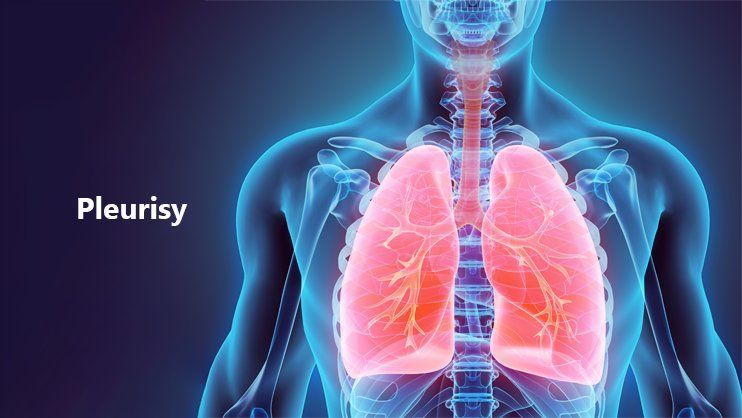 التهاب الجنبة pleurisy: الأسباب والأعراض والتشخيص والعلاج