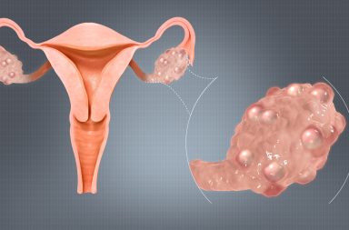 كيفية معرفة وجود تكيس المبايض - الكيسات المبيضية الحميدة Benign Ovarian Cysts - كيس مملوء بسائل يتشكل في المبيض - النزيف الشديد أثناء الحيض - كيسات المبيض